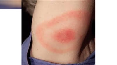 تحذير.. 6 أعراض شبيهة بالإنفلونزا تكشف إصابتك بمرض قاتل