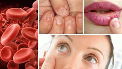 من ضعف الشهية إلى الجلد الشاحب.. أعراض نقص الحديد في الجسم