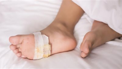 أمل جديد.. فيتامين شهير يمنع إصابة مرضى السكر بقرحة القدم السكرية