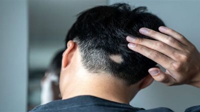 بشرى سارة.. الموافقة على أول دواء يؤخذ عبر الفم لعلاج داء الثعلبة