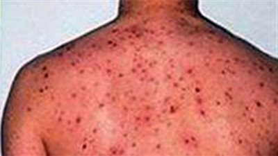 نزيف تحت الجلد وفشل كبدي.. الحمى النزفية خطر قادم