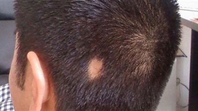 الأول من نوعه.. أمريكا تجيز دواء لعلاج الثعلبة‏