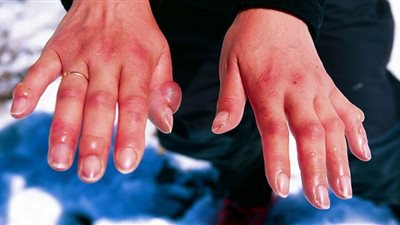 (فيديو).. نصائح مهمة لتجنب الإصابة بعضة البرد المسببة لـ الغرغرينا