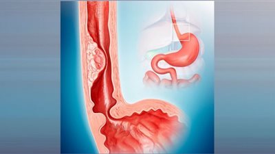 احذر.. خضروات تزيد من خطر إصابتك بسرطان المرىء
