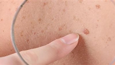 انتبه لها.. علامة تخبرك بإصابتك بسرطان الجلد