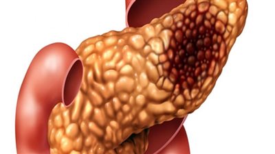 علماء يكتشفون علاقة بين فصيلة الدم والإصابة بسرطان البنكرياس