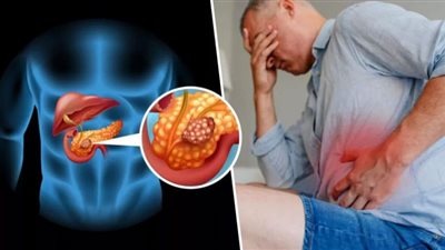 3 أعراض تشير إلى إصابتك بـ سرطان البنكرياس