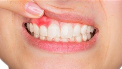 ما أعراض التهاب اللثة؟