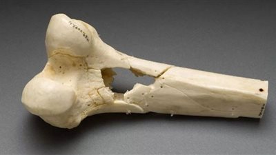 علامات تدل على الإصابة بـ سرطان العظام