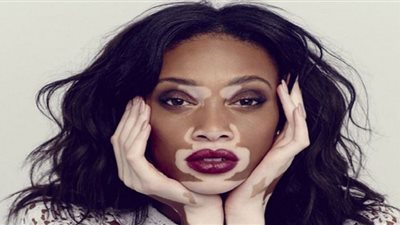 تعرف على مرض البهاق ومسبباته