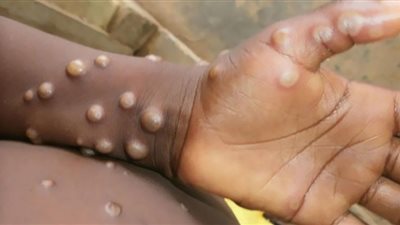 الصحة العالمية تحذر من انتقال جدري القردة للأطفال والحوامل
