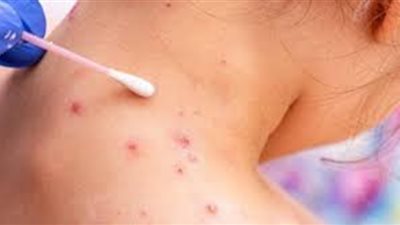 تركيا تعلن تسجيل أول إصابة بمرض جدري القرود في البلاد