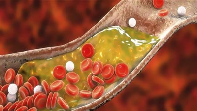 شعور في المعدة يشير إلى ارتفاع مستويات الكوليسترول بشكل خطير