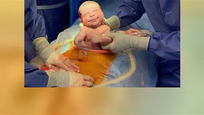 الولادة القيصرية ترتفع أكثر من 5 أضعاف في مصر (شاهد)