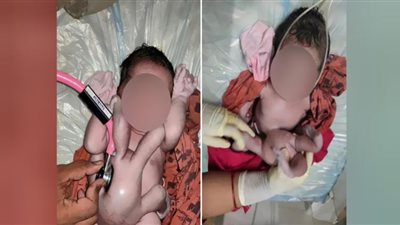معجزة.. ولادة طفلة بأربع أذرع وأرجل في الهند (صور)
