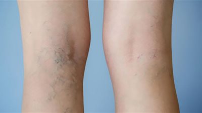 طبيبة روسية تكشف طرق لمنع ظهور الدوالي