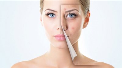 تخلصي من حب الشباب في العيد.. طريقة عمل ماسك زبدة الشيا للوجه