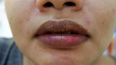 3 مكونات لعلاج إسمرار الشفاة في المنزل