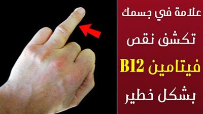 نقص هذا الفيتامين يهدد حياتك بمرض ليس له علاج.. طبيب يحذر