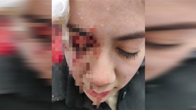 رفضت معاكساته..عاطل يشوه وجه فتاة بسلاح أبيض قبل حفل زفافها في شبرا الخيمة