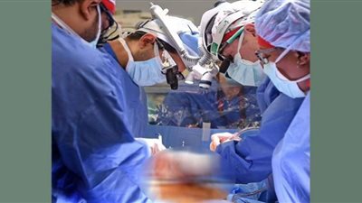 زرع قلبي خنزيرين لشخصين ميتين دماغيًا (شاهد)