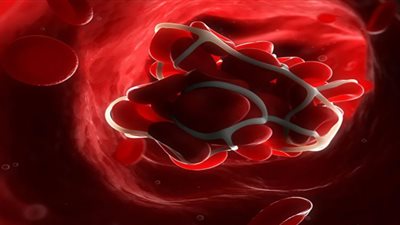 مشروب شهير يعزز خطر التجلط