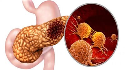 لماذا يطلق على سرطان البنكرياس اسم المرض الصامت؟