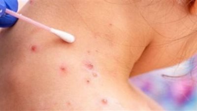 الولايات المتحدة تفشل في احتواء تفشي مرض جدري القرود.. مسؤول أمريكي يوضح