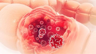 5 خطوات للوقاية من سرطان القولون