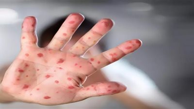 الإصابة بجدرى القرود تؤدى لمضاعفات عصبية