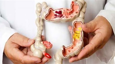 عارض يظهر ليلًا يدل على انتشار سرطان الأمعاء