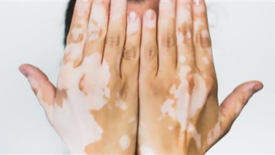 هيئة الغذاء والدواء الأمريكية توافق على أول علاج لمرض البهاق