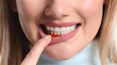 من نزيف اللثة إلى القرحة.. ماذا يكشف لك فمك عن صحتك