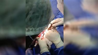 استئصال كامل للقولون وتحويل مسار لمسن بمستشفى ميت غمر المركزي بالدقهلية