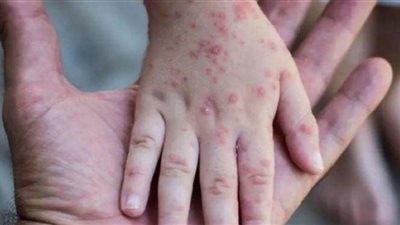 منظمة الصحة تعلن جدري القرود حالة طوارئ عالمية