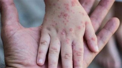 الفئات الأكثر عرضة للإصابة بجدري القرود