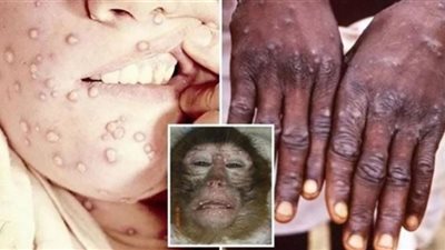 طرق الوقاية من جدري القرود بعد انتشاره في 75 دولة