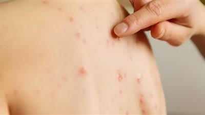 الإمارات تسجل 3 إصابات جديدة بجدري القردة