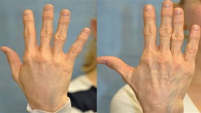 وصفة ساحرة لعلاج تجاعيد اليدين واستعادة شبابها