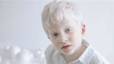 أهم المعلومات عن مرض الألبينو