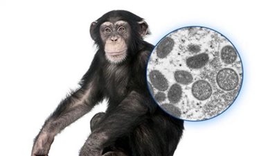 3 طرق لانتشار عدوى جدري القرود.. تفاصيل