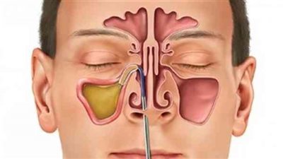 طرق بسيطة لعلاج التهاب الجيوب الأنفية