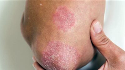 علماء يطورون تقنية لتحليل حالة الجلد دون جرَّاح