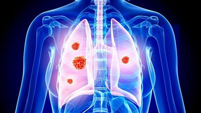فيروس كورونا له فوائد لإنقاذ مرضى سرطان الرئة