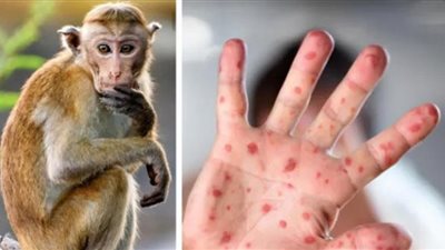 الصحة العالمية تكشف مفاجأة جديدة حول جدري القرود