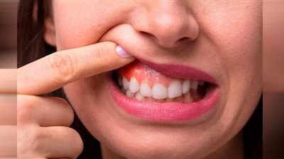 3 أمراض تؤثر بشكل كبير على أمراض اللثة