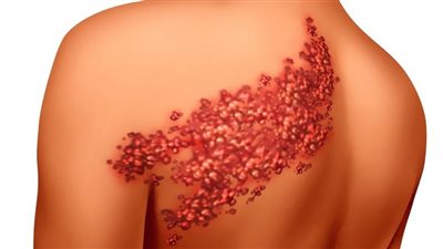 الحزام الناري.. أعراضه وكيفية العلاج