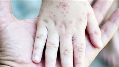 بعد إعلان حالة الطوارئ عالميًا.. أستراليا ترفع حالة التأهب بسبب جدرى القرود