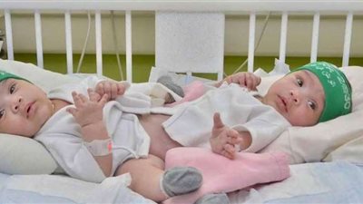 نجاح عملية فصل توأم سيامي يمني بمشاركة 28 طبيبًا (شاهد)