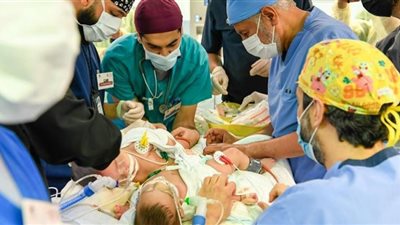 فصل التوأم مودة ورحمة.. إنجاز تدمع له الأعين (صور)